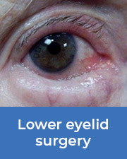 Close up on eye in need of a lower eyelid surgery