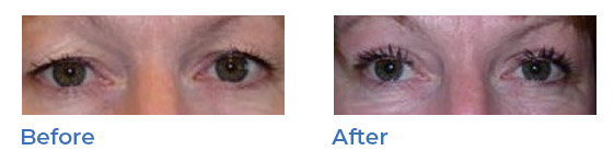 Blepharoplasty, or upper eyelid surgery, image 05
