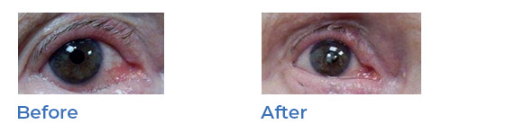 Lower eyelid surgery image 01