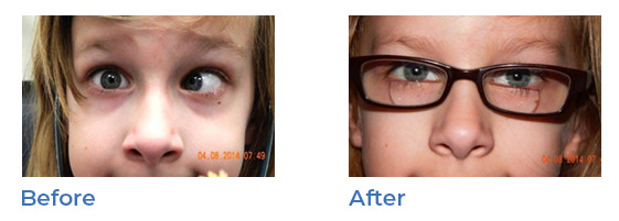 strabismus - before and after 01